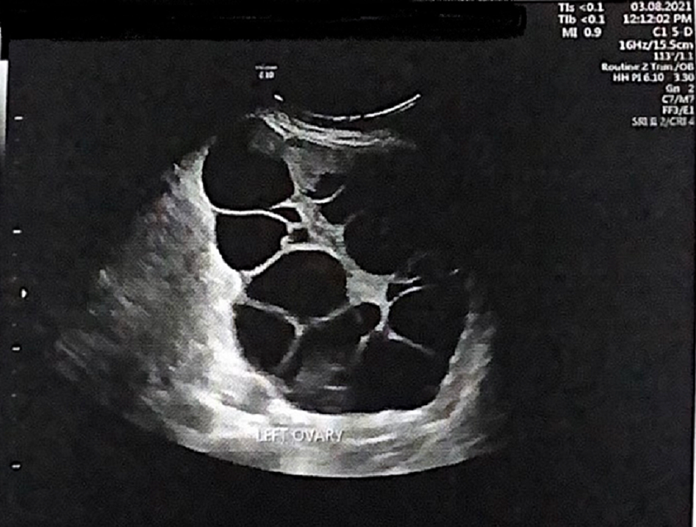 Onset Of Spontaneous Ovarian Hyperstimulation Syndrome In The Third ...