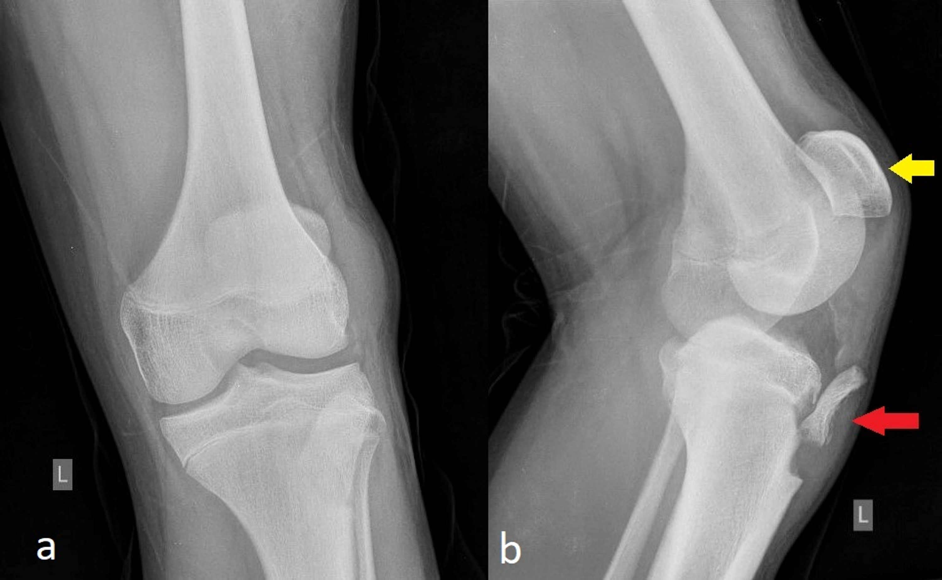 patellar tendon rupture