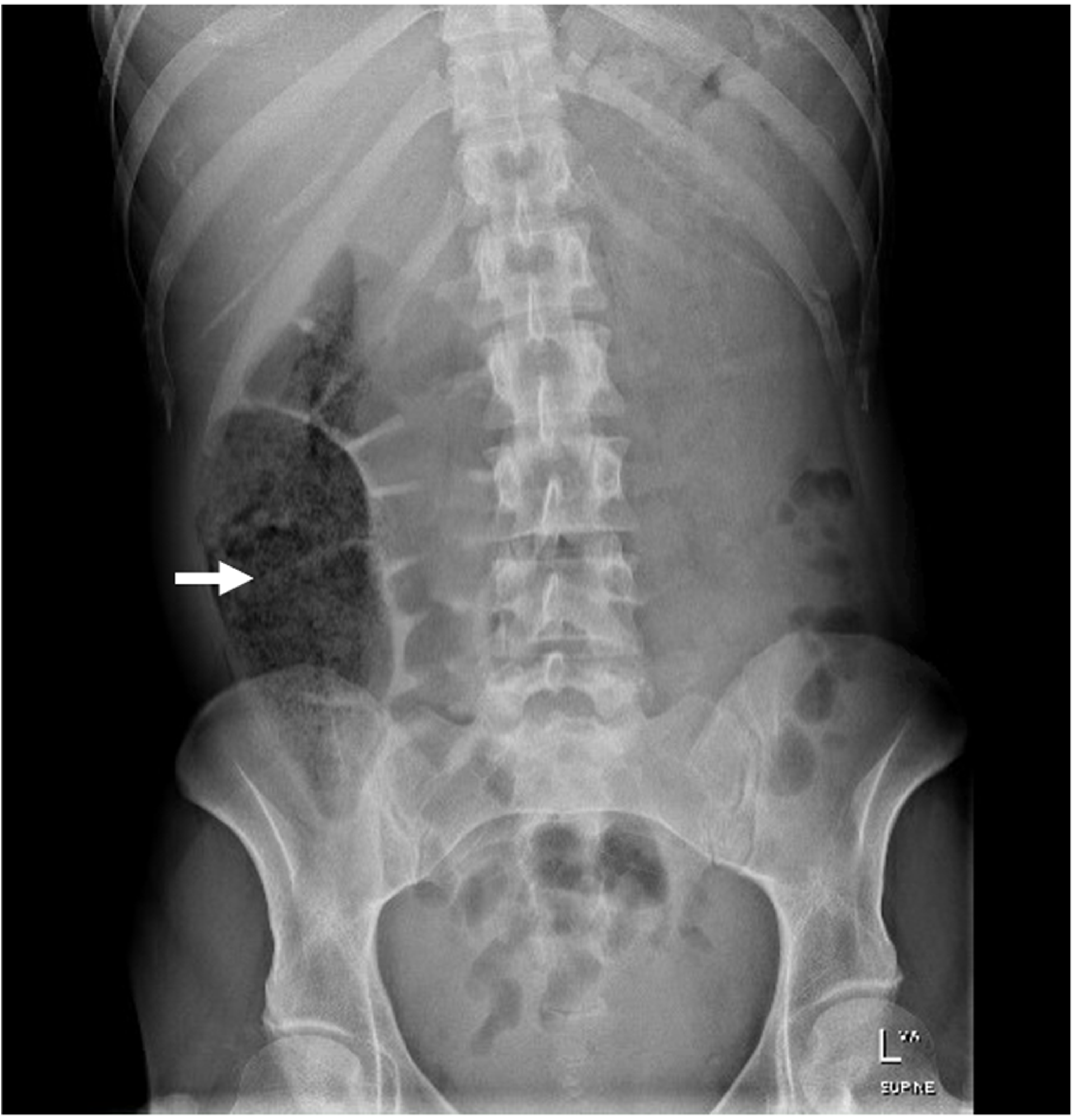 Cureus | Acute Presentation of Rapunzel Syndrome and a Review of Bezoars