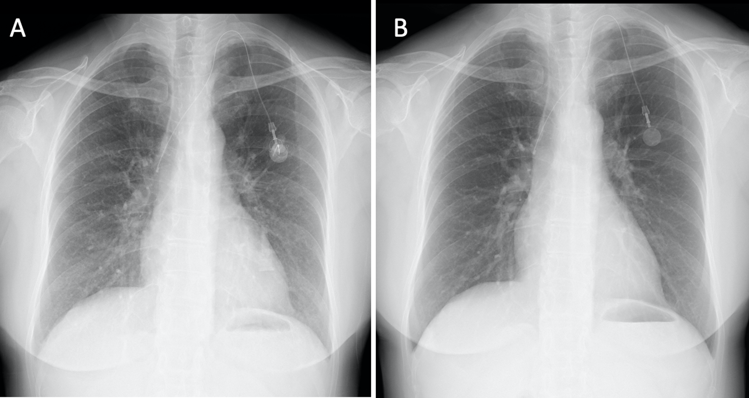 Cureus | A Case of Drug-Induced Interstitial Lung Disease Caused by ...