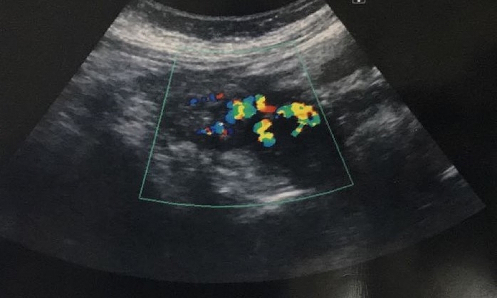 cureus-role-of-uterine-artery-embolization-in-pseudoaneurysm-of