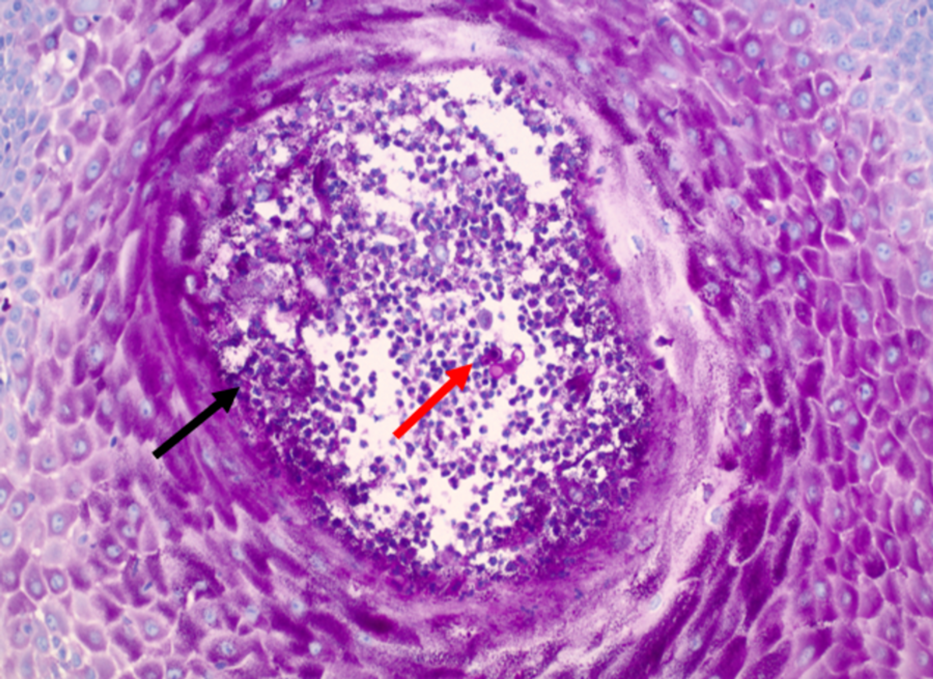 blastomycosis histology