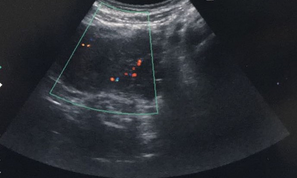 Cureus | Role Of Uterine Artery Embolization In Pseudoaneurysm Of ...