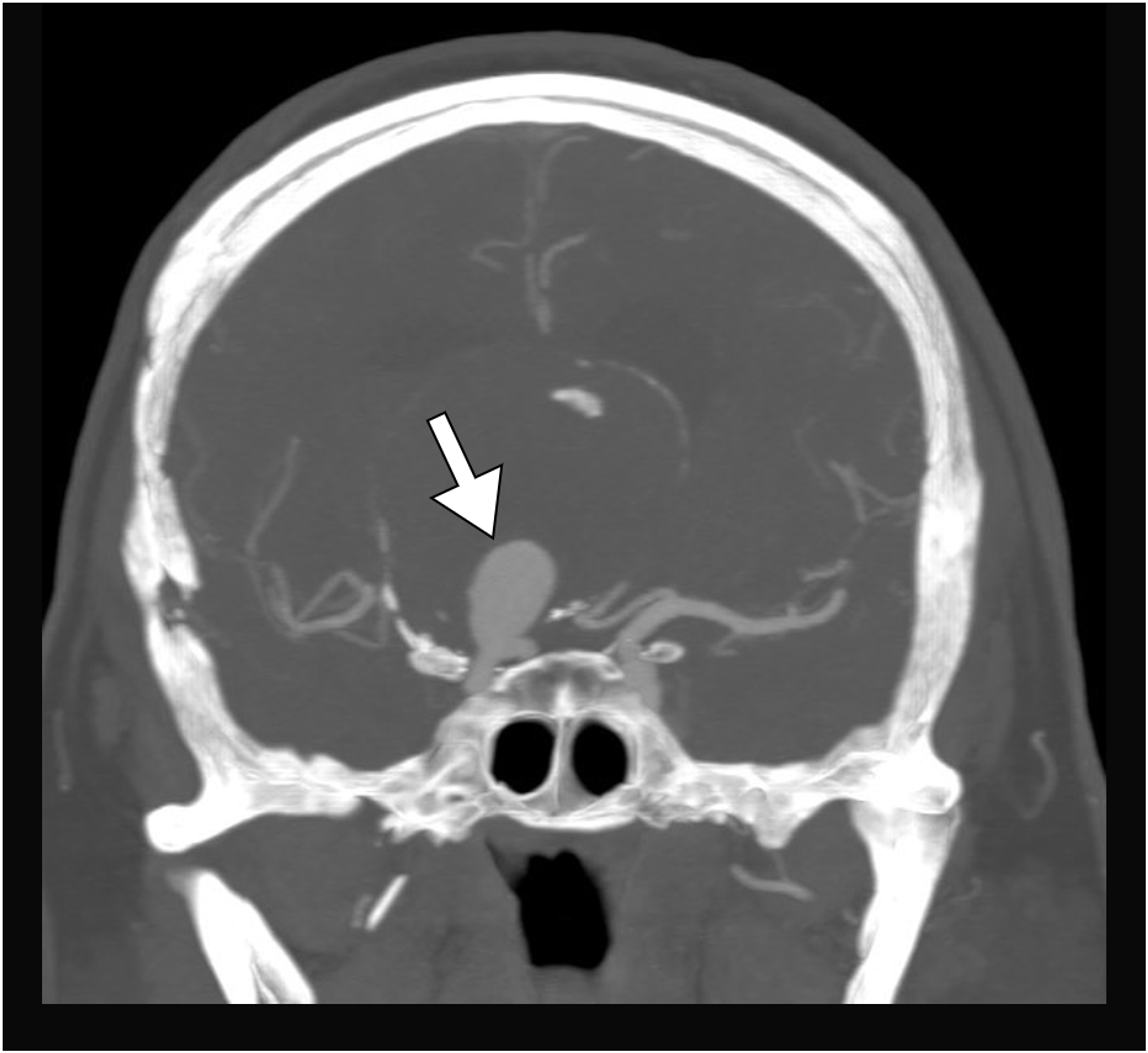 Cureus Giant Unruptured Internal Carotid Artery Aneurysm 4693