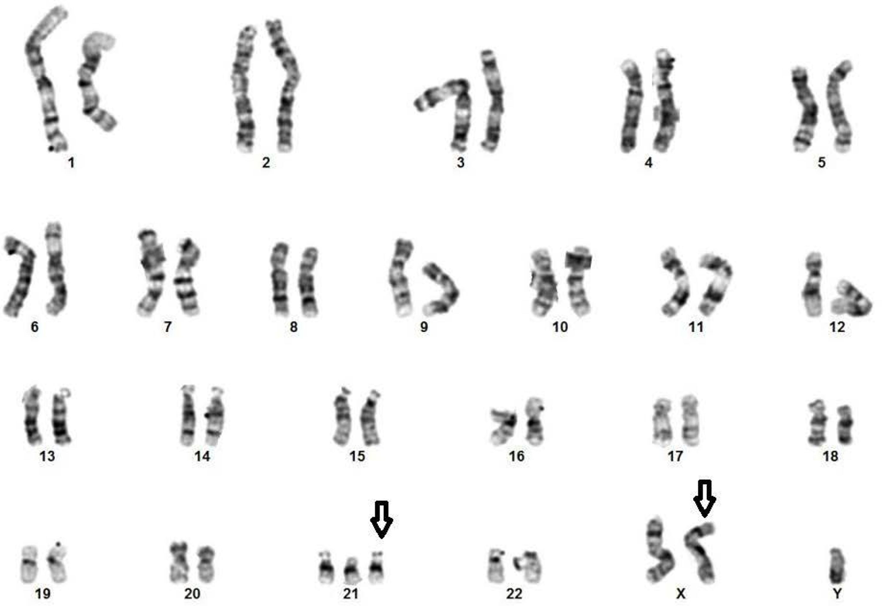 Cureus | Down-Klinefelter Syndrome (48,XXY,+21) in a Saudi Neonate: A ...