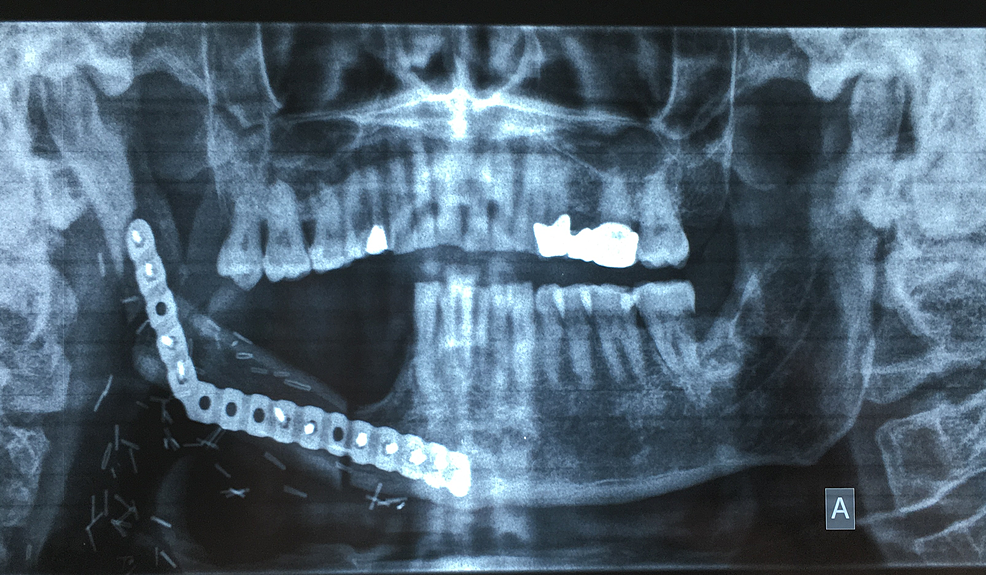 Orthopantomogram-showing-the-adaptation-of-the-fibula-to-the--right-mandibular-defect.