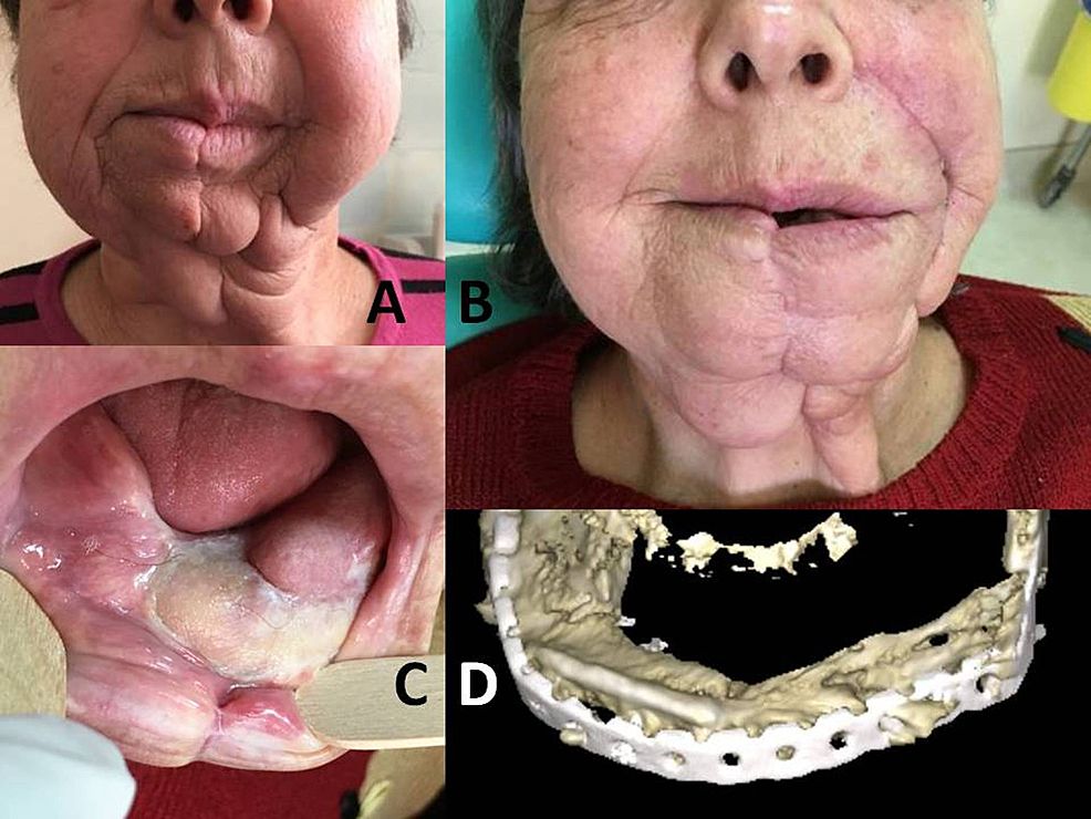A:-Face-disfigurement-after-mandibulectomy-for-squamous-oral-carcinoma-and-early-removal-of-the-plate-due-to-infection.-B:-Postoperative-appearance-of-the-patient-after-fibula-flap-reconstruction.-C:-Intraoral-view-of-the-skin-part-of-the-fibula-osteo-cutaneous-flap.-Satisfactory-mouth-opening.-D:-Postoperative-3D-CT,-showing-the-reconstructed-mandible.-