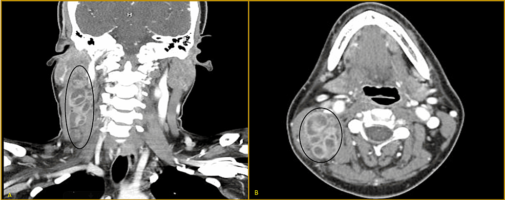 CT-scan-of-the-neck-showing-hypoattenuating/centrally-necrotic-glomerate-lymph-node-mass-(4.2-x-7.4-cm);-Black-circle-in-coronal-section-(A),-and-transverse-section-(B)
