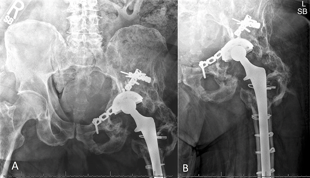 Total Hip Replacement FAQ - Scottsdale Joint Center