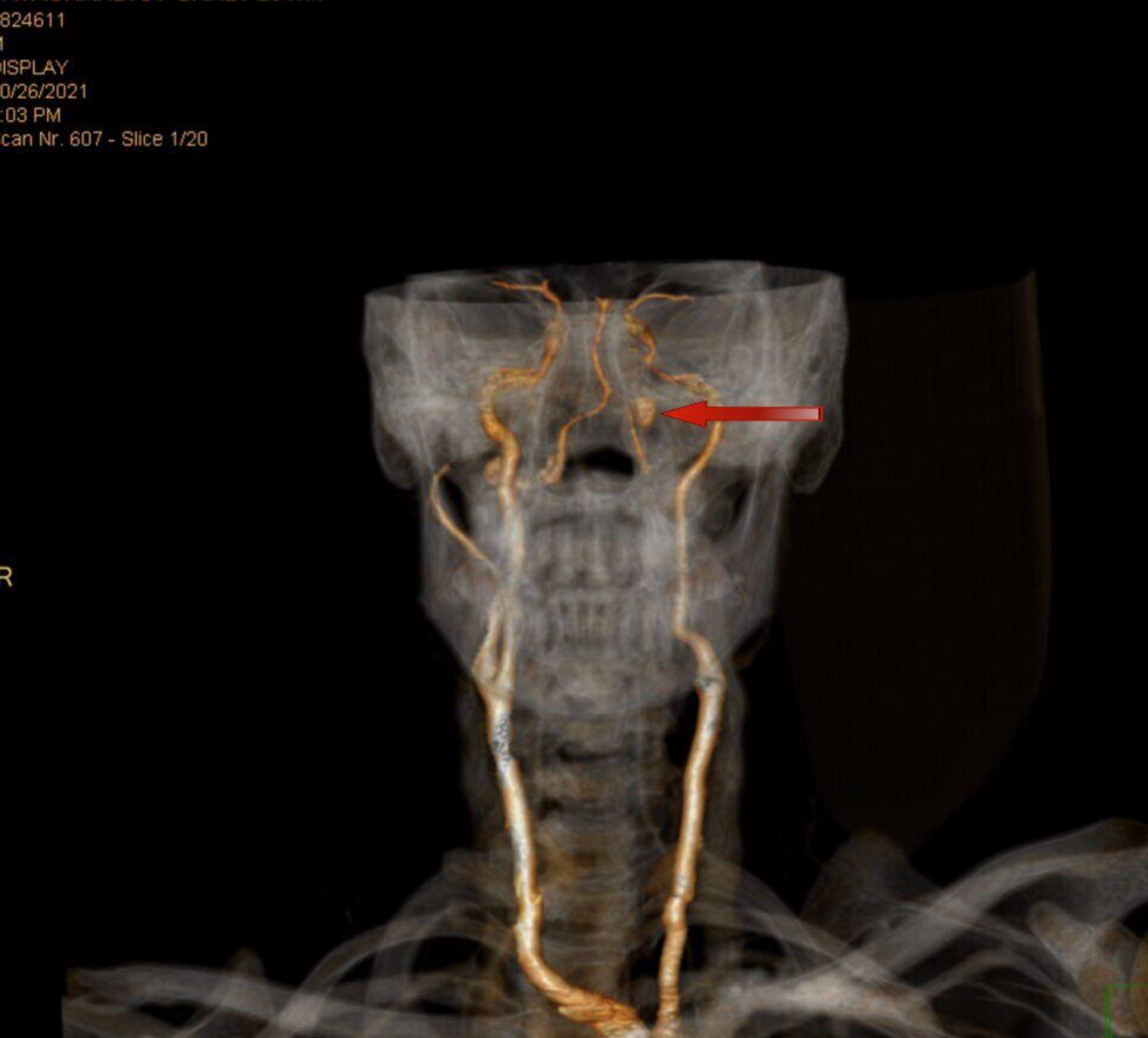 Pictures Of Scars From Carotid Artery Surgery - a0gr230