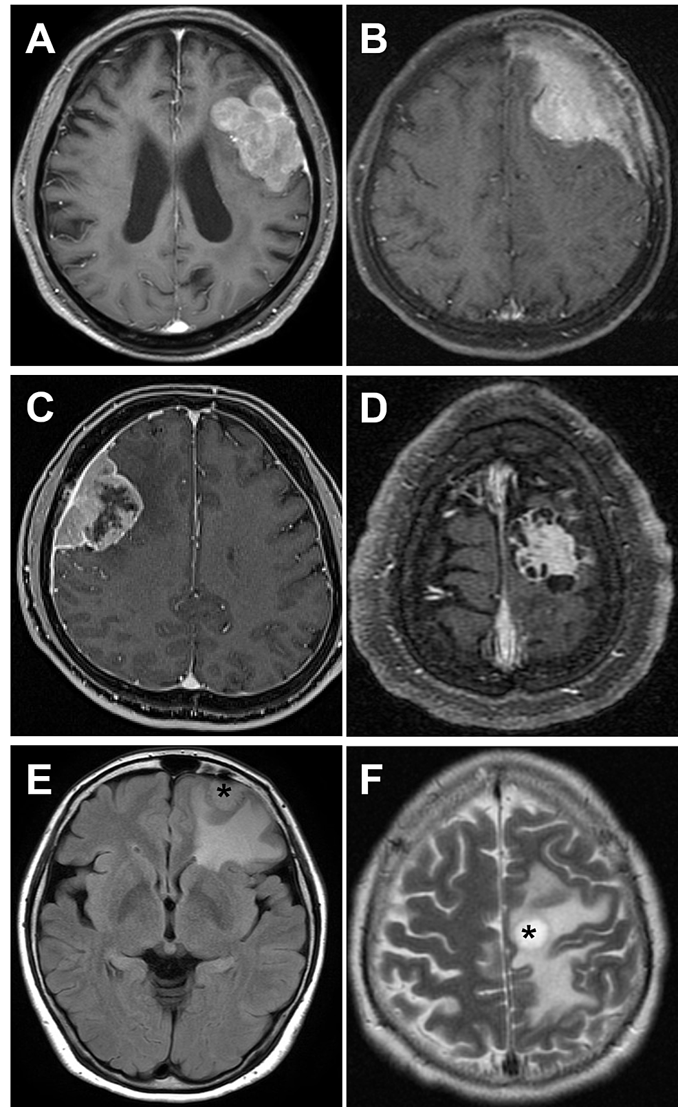 Preoperative Prediction of Intracranial Meningioma Grade Using