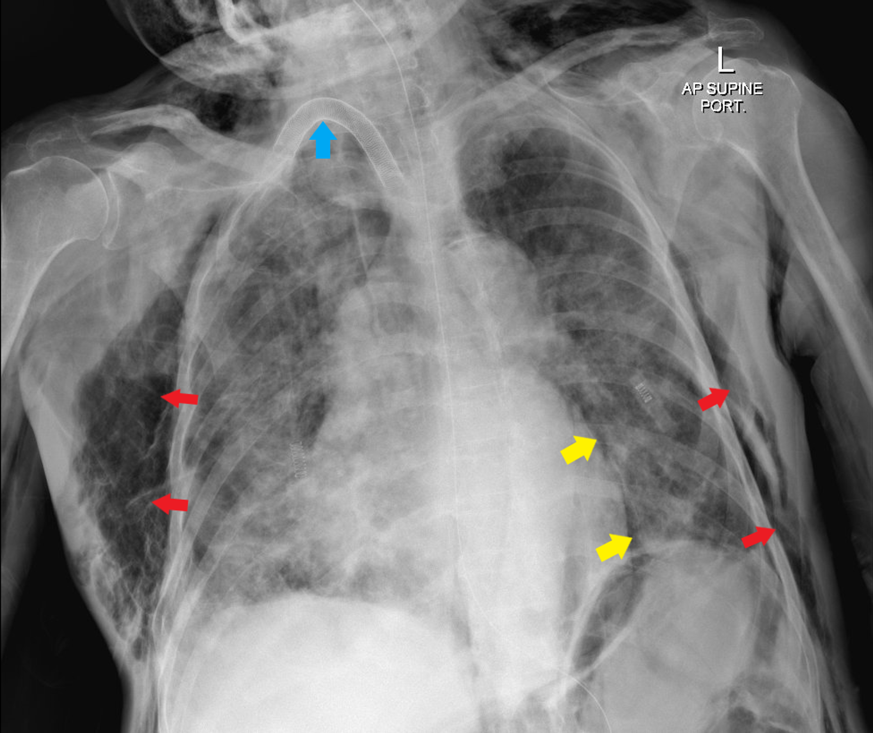 Cureus A Case of Complicated Traumatic Generalized Surgical Emphysema