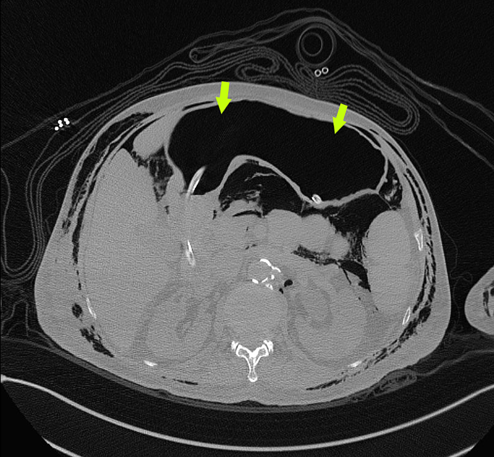 Cureus A Case Of Complicated Traumatic Generalized Surgical Emphysema