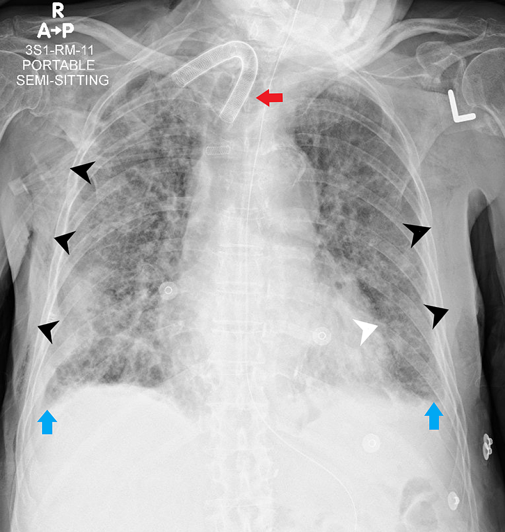 Cureus A Case Of Complicated Traumatic Generalized Surgical Emphysema