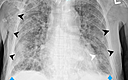 Cureus A Case Of Complicated Traumatic Generalized Surgical Emphysema