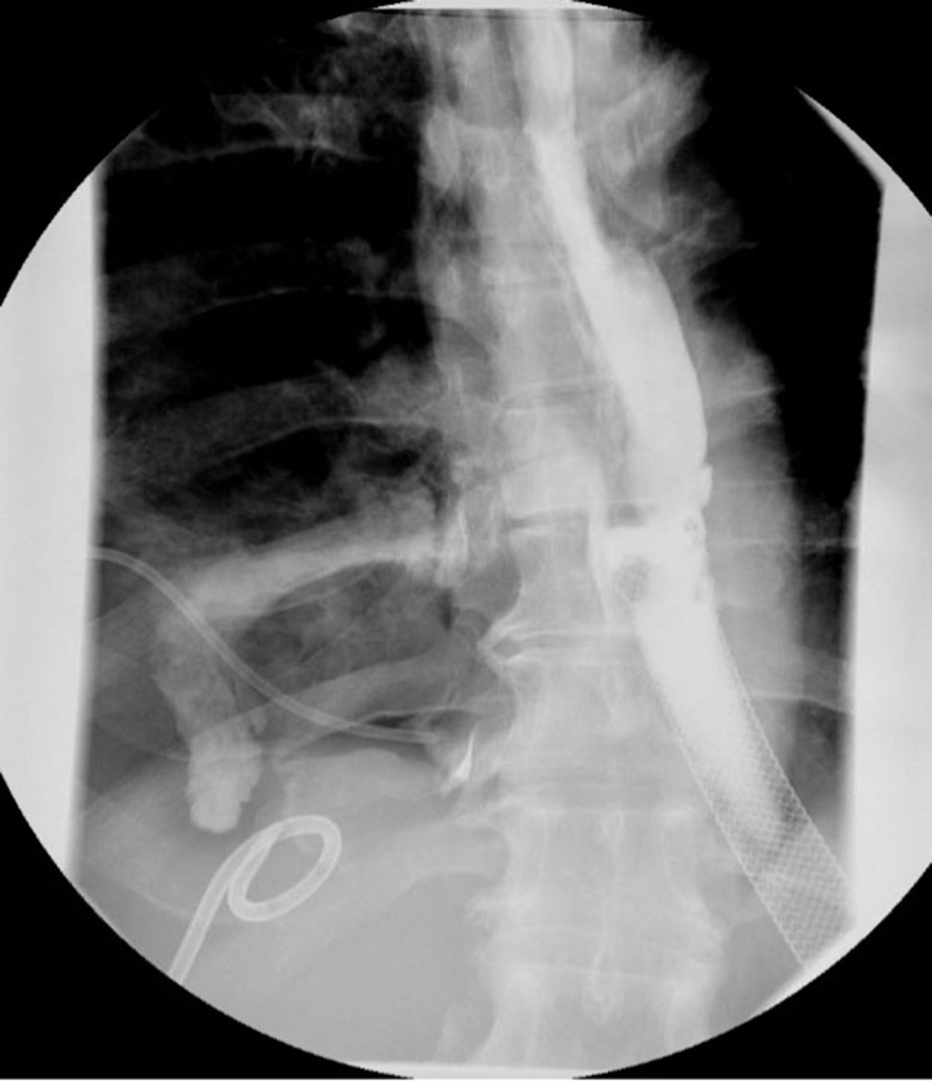 Cureus OvertheScope Clip Closure of an EsophagealPleural Fistula