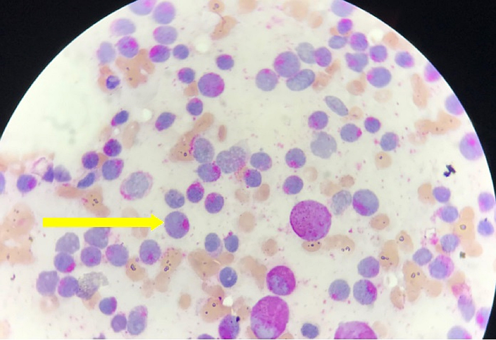 Cureus Acute Myeloid Leukemia With Systemic Lupus Erythematosus Rare