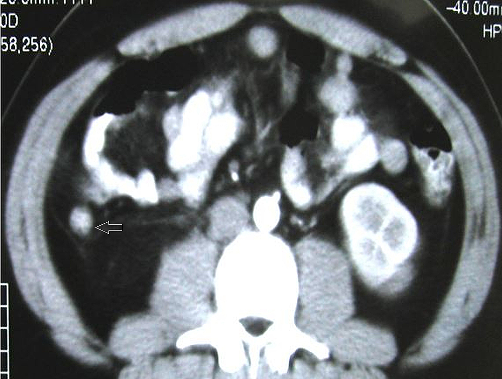 Cureus | Diagnostic Efficiency of Multidetector Computed Tomography in ...