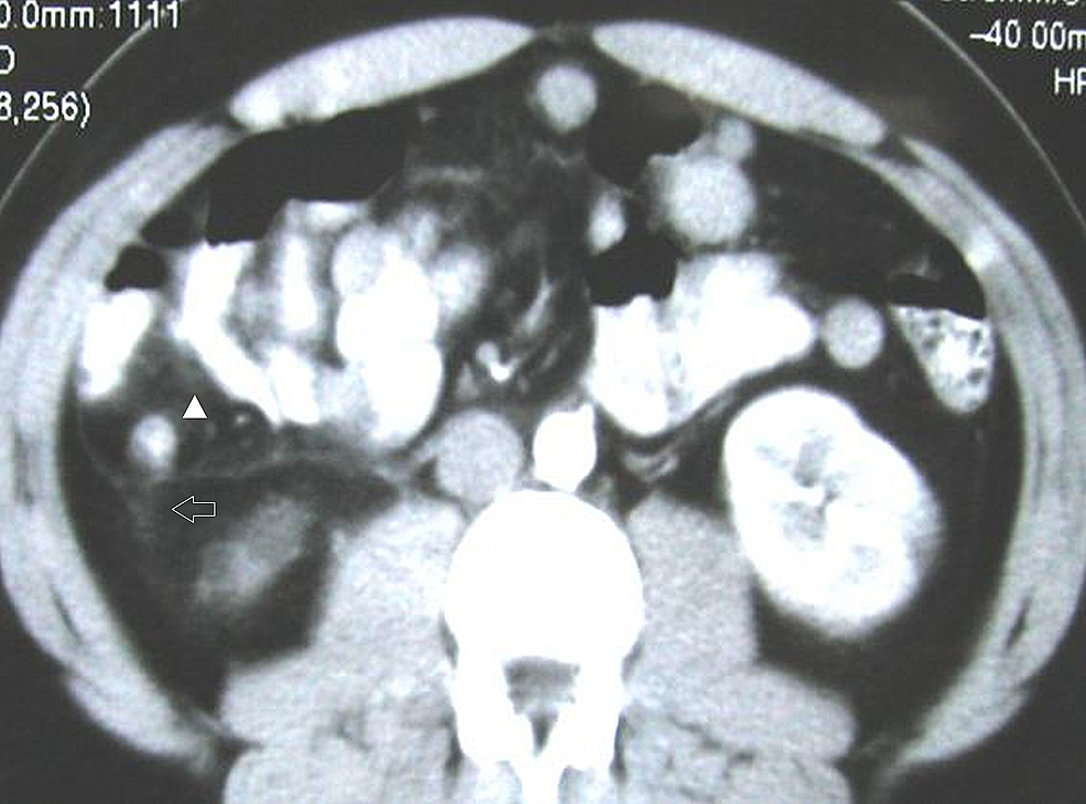 fibrous obliteration of appendix