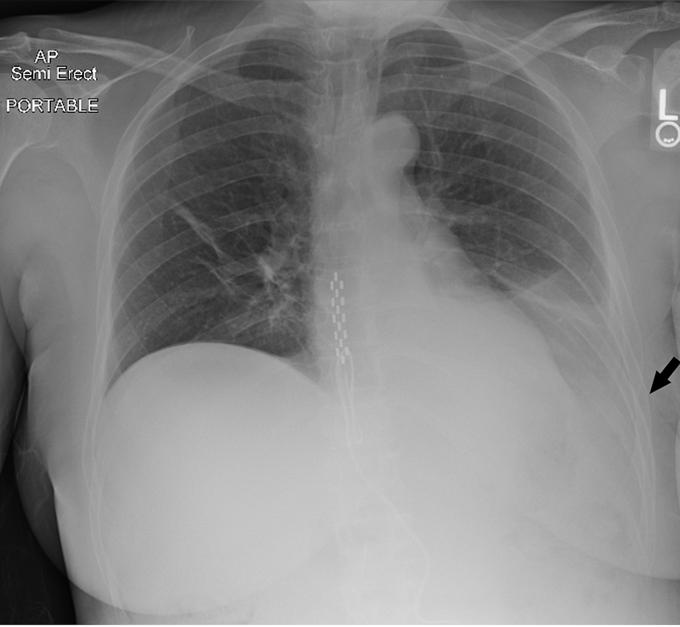 Chylous Pleural Effusion