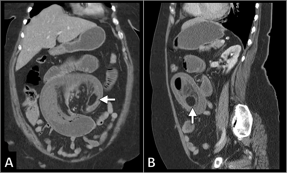 Cureus Intussusception In Adults A Rare Etiology Of Small Intestinal Obstruction 