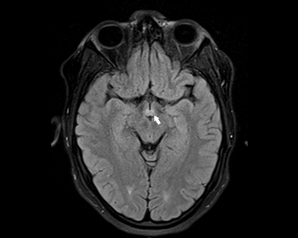 Cureus, Brainstem and Spinal Arachnoiditis Ossificans Associated With  Neurocysticercosis: A Case Report