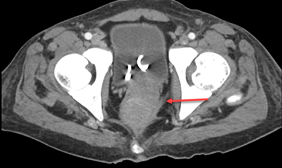 Cureus | Metastatic Castrate-Resistant Prostate Cancer: A Rare Cause of ...