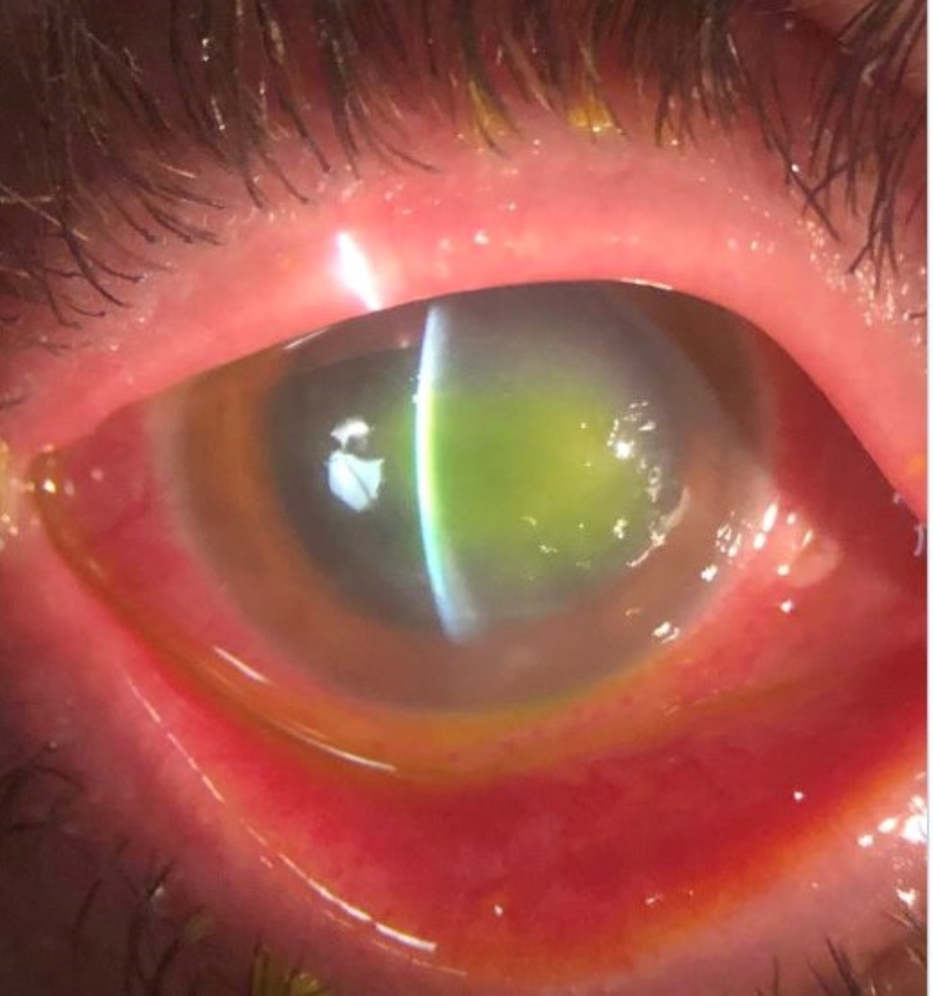 acanthamoeba corneal ulcer