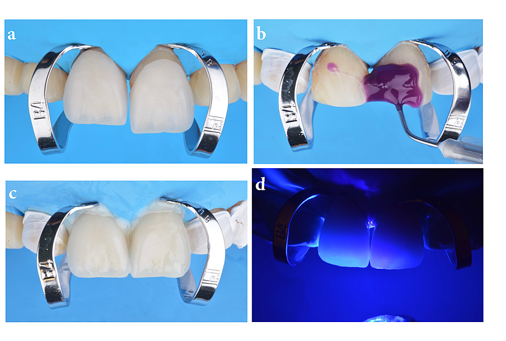 Rubber Dam Isolation for Bonding Ceramic Veneers A FiveYear Post
