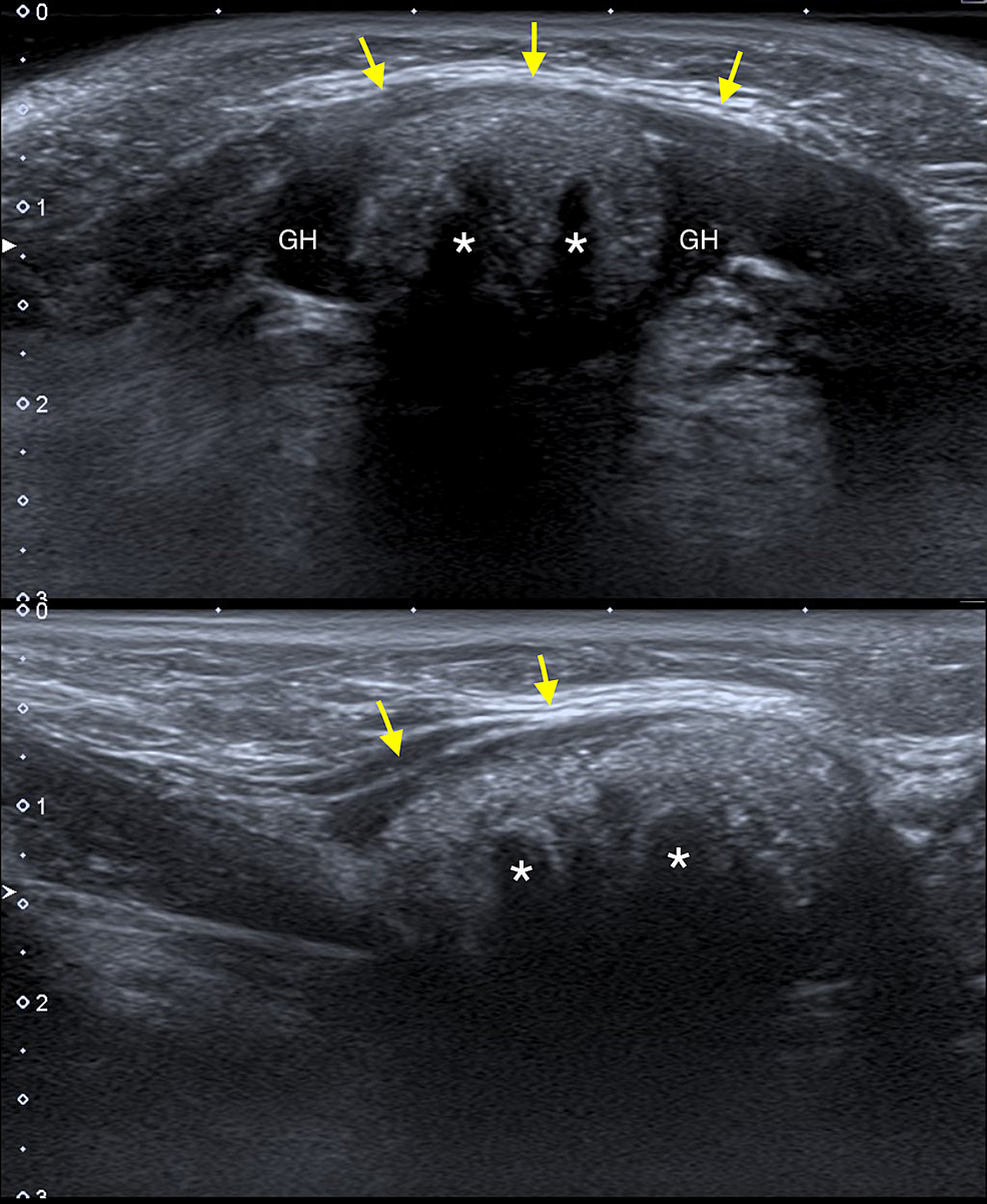 subcutaneous dermoid cyst ultrasound