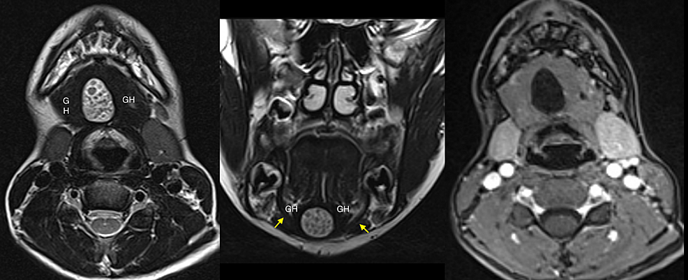 Cureus Dermoid Cyst Of The Floor Of The Mouth Diagnostic