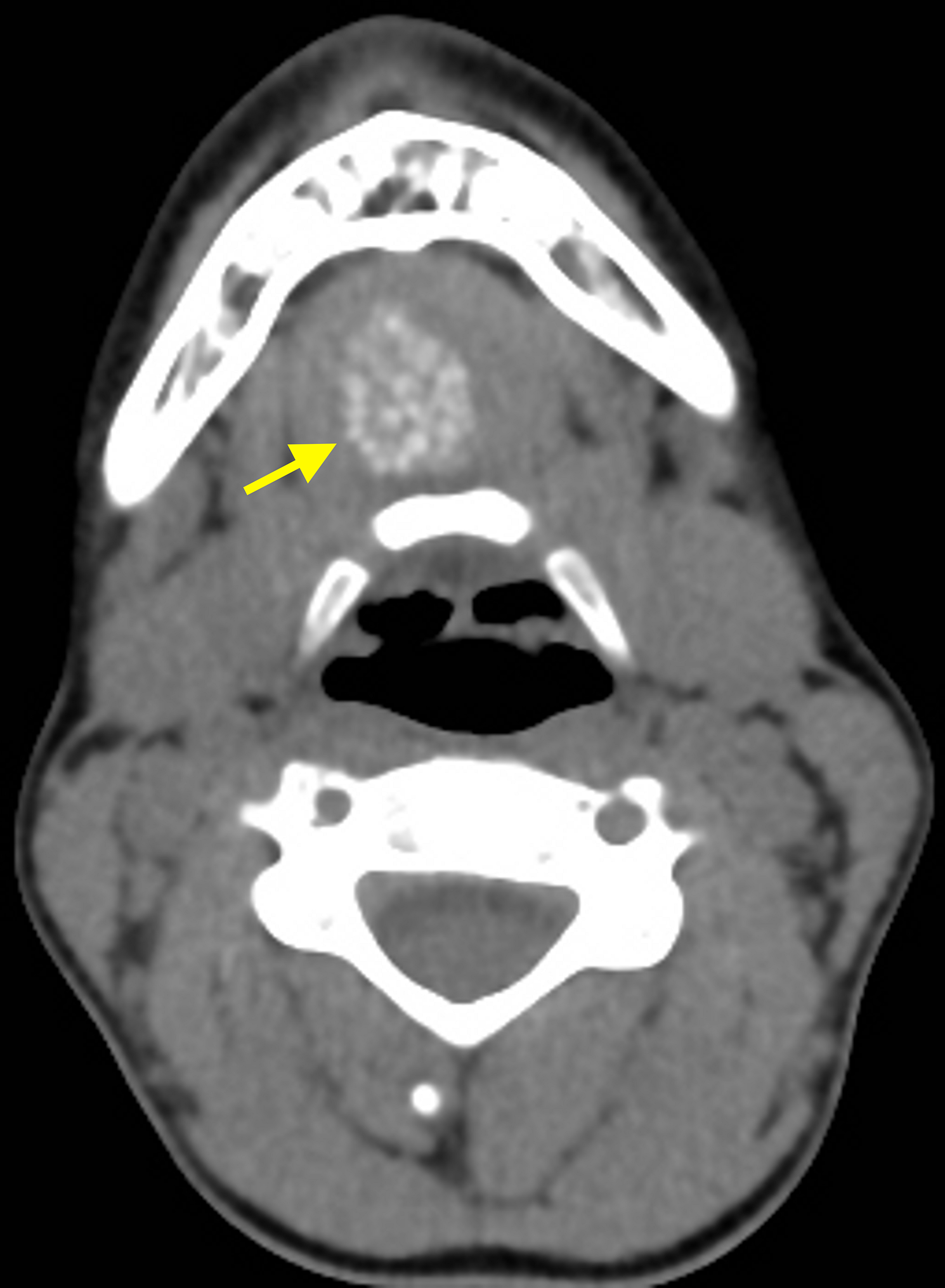 Muscles Of Floor Of Mouth Mri Carpet Vidalondon