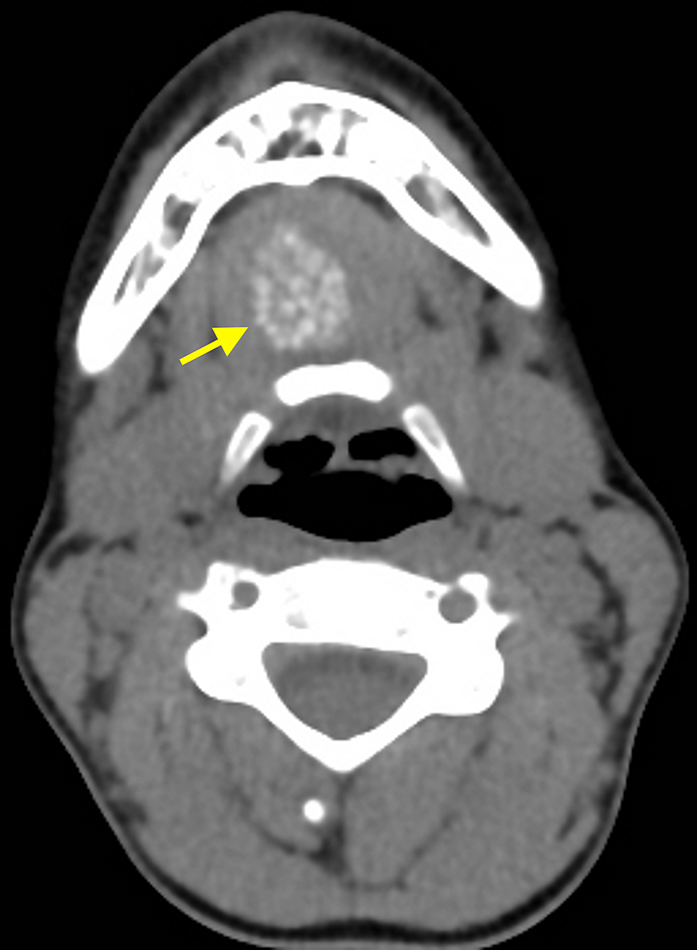 Cureus Dermoid Cyst Of The Floor Of The Mouth Diagnostic