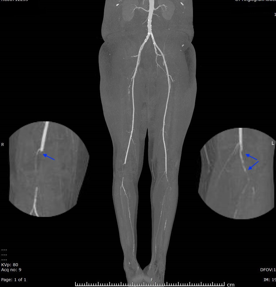 Cureus A Rare Case of Bilateral Popliteal Artery Occlusion