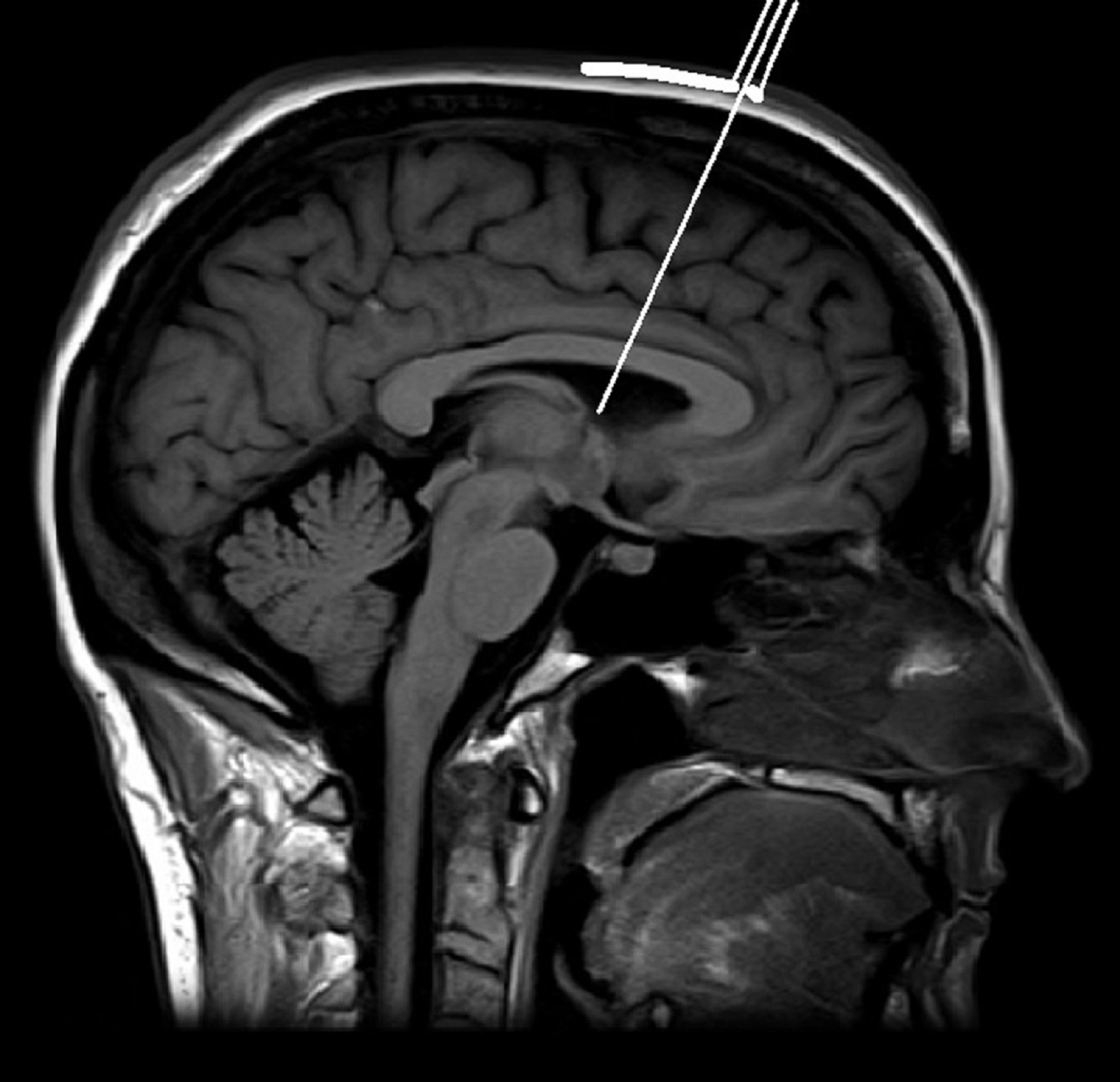 Cureus | Stereotactic Ventriculostomy Guide