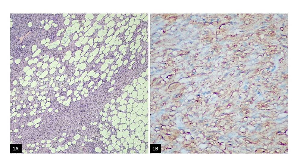 Diagnostic Challenges of Protuberans (DFSP), a Rare