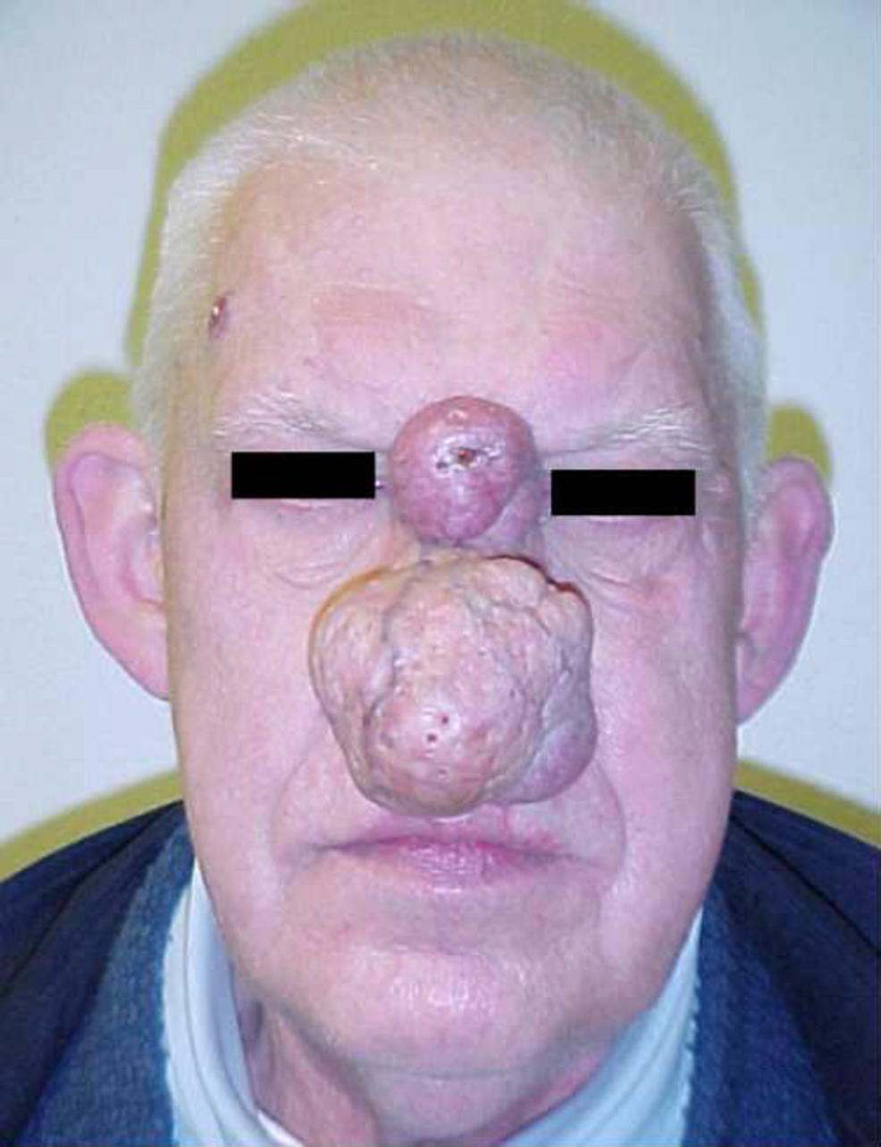 Frontal-preoperative-appearance