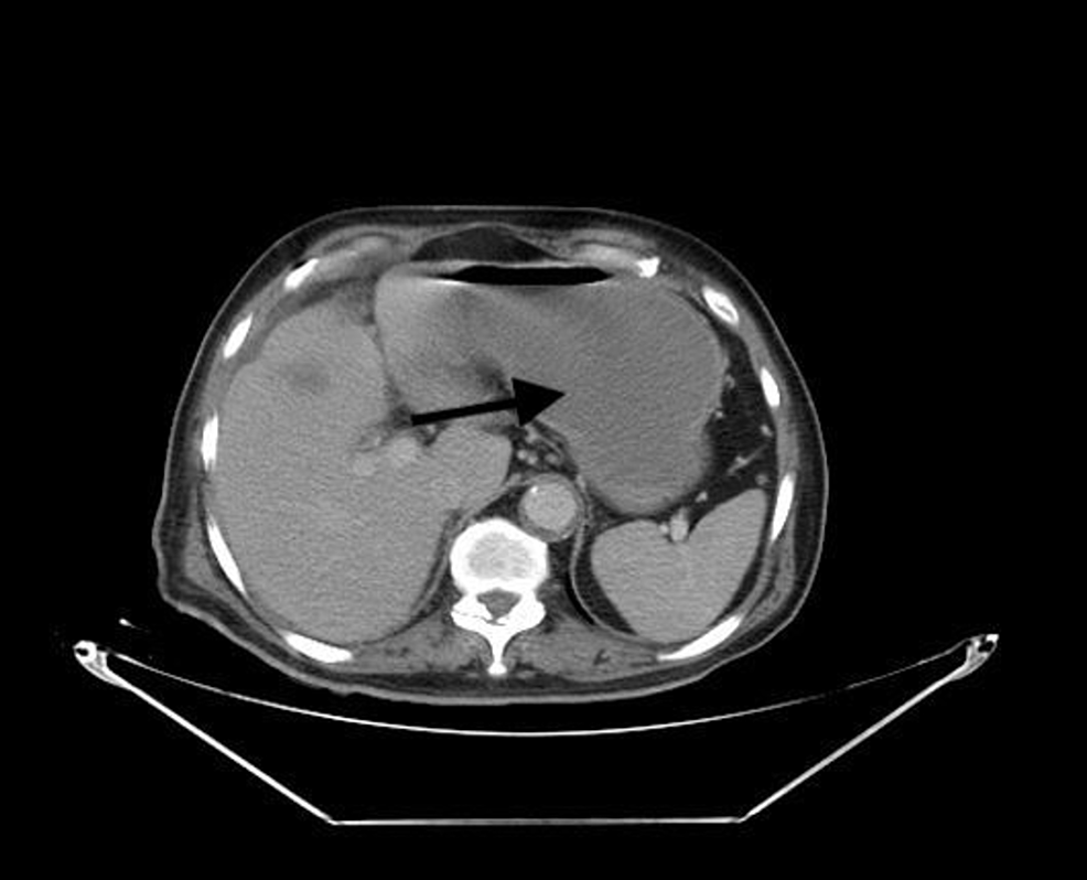 Abdominal-CT-scan-showing-distended-stomach-(arrow)-10-days-post-operatively