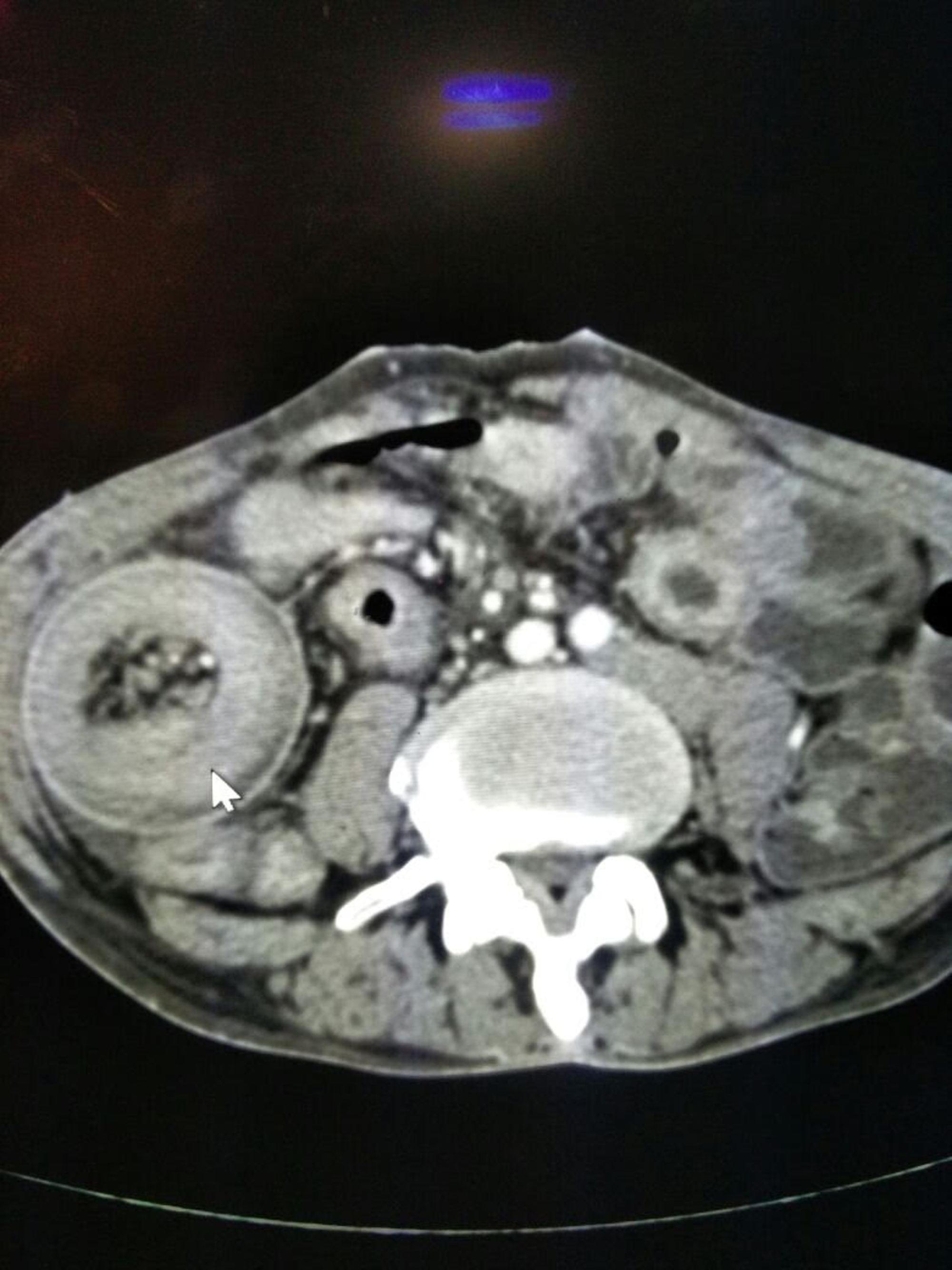 Cureus A Surgical Conundrum In Feeding Jejunostomy Jejunojejunal Intussusception A Case Series
