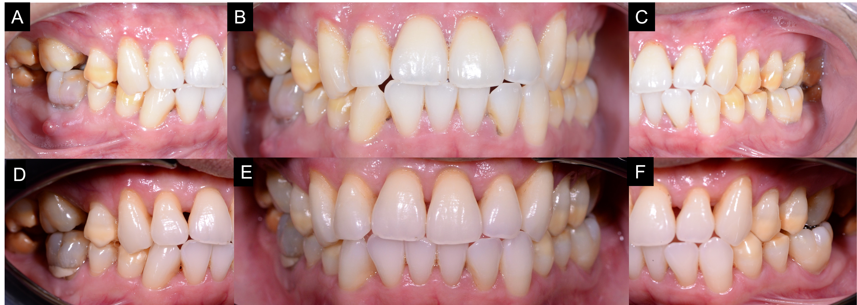 best toothpaste for tetracycline stained teeth