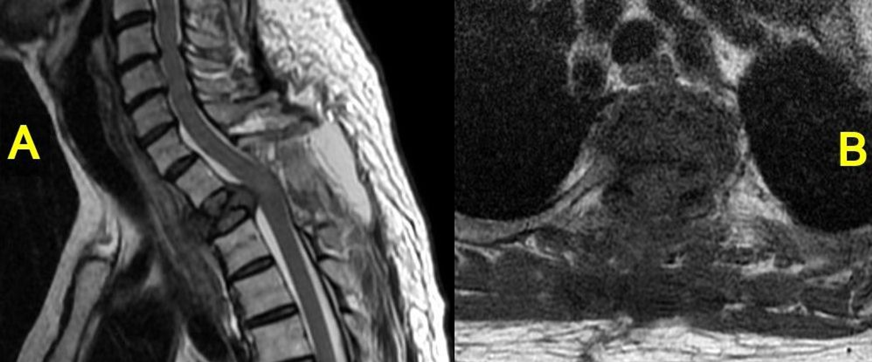 De Actualidad 268vtr Prostate Cancer Metastasis Spine Treatment
