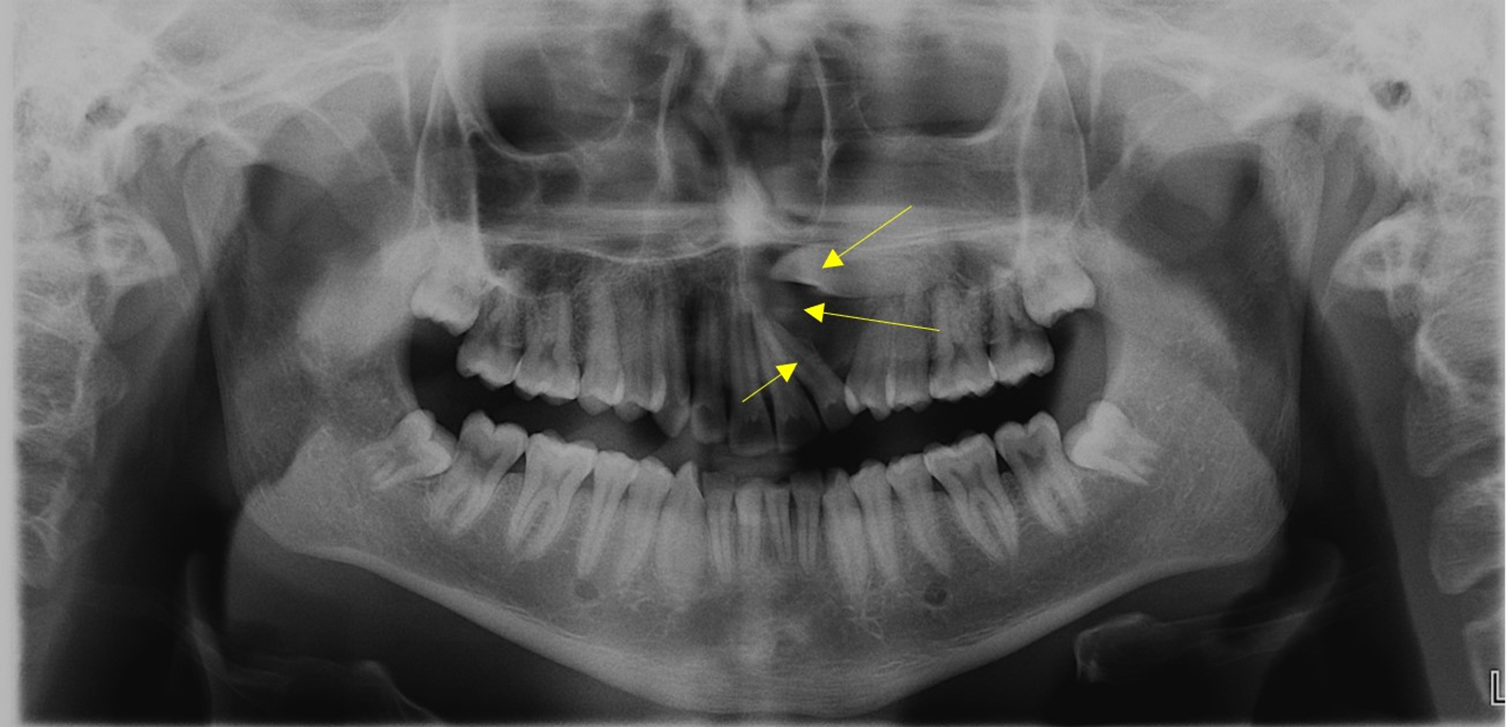 Cureus An Unusually Large Parakeratinised Odontogenic Keratocyst in