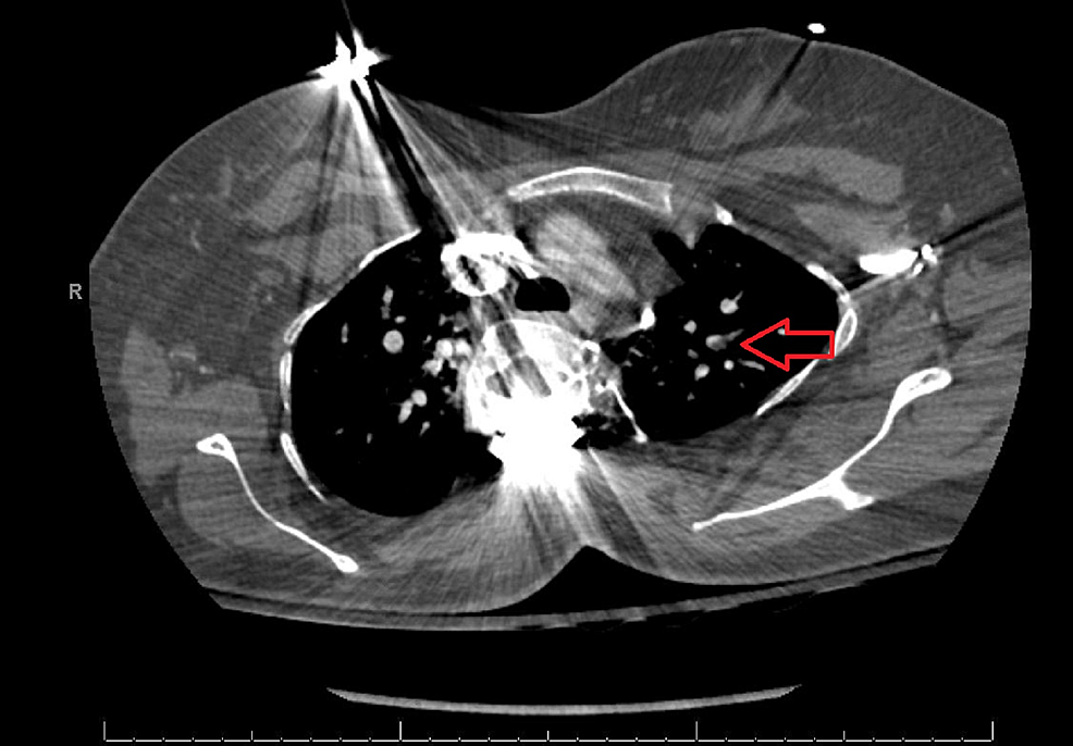 CT-pulmonary-angiography.