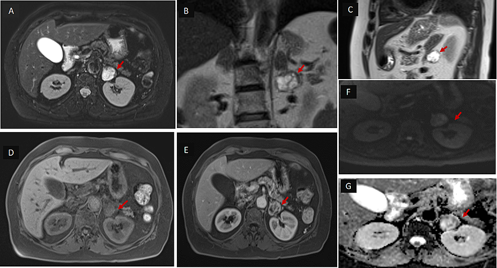 MRI-abdomen:-exophytic-lesion-(red-arrow)-measuring-2.8-x-2.6-cm-inferior-to-the-left-adrenal-gland-abutting-along-the-medial-cortex-of-the-left-kidney-with-persistent-fat-planes
