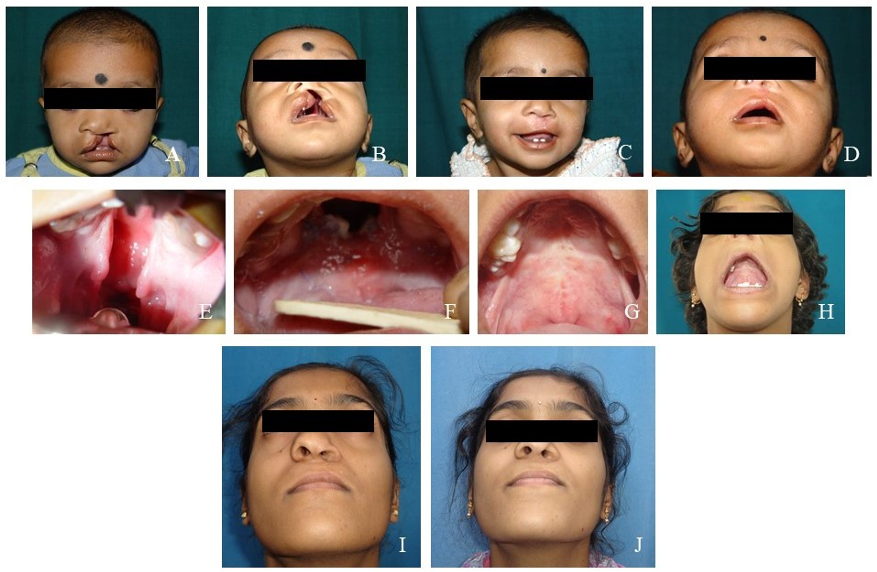 cleft lip and palate adult