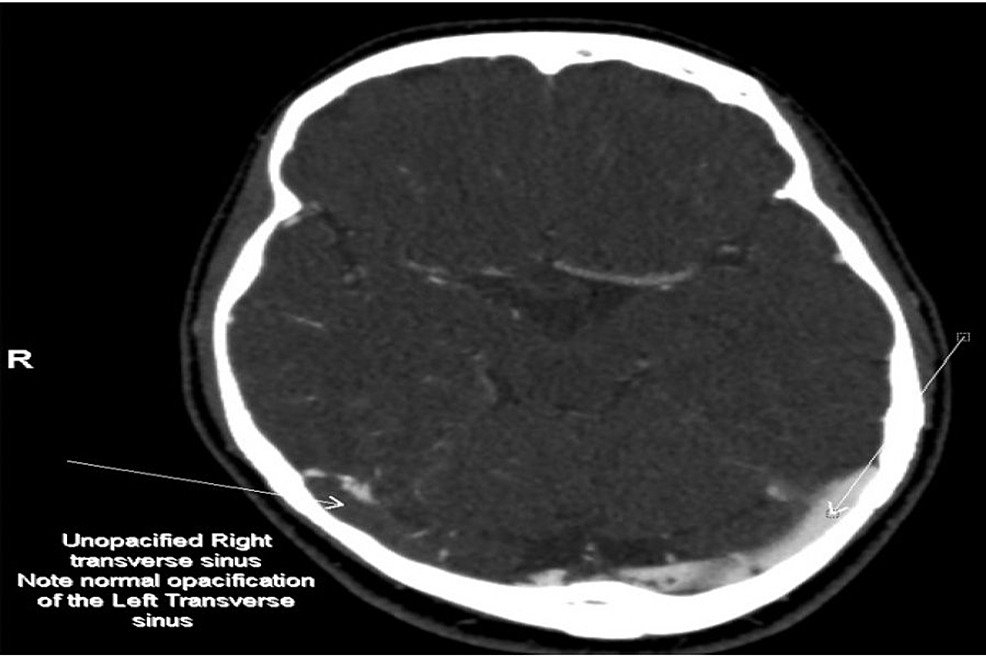 Axial-view-of-the-CT-cerebral-Venogram-shows-unopacified,-thrombosed-Right-Transverse-sinus.