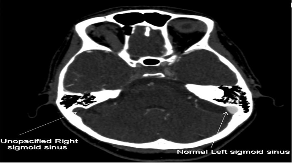 Axial-view-of-the-CT-cerebral-Venogram-demonstrates-non-enhancement-of-the-thrombosed-Right-Sigmoid-sinus.