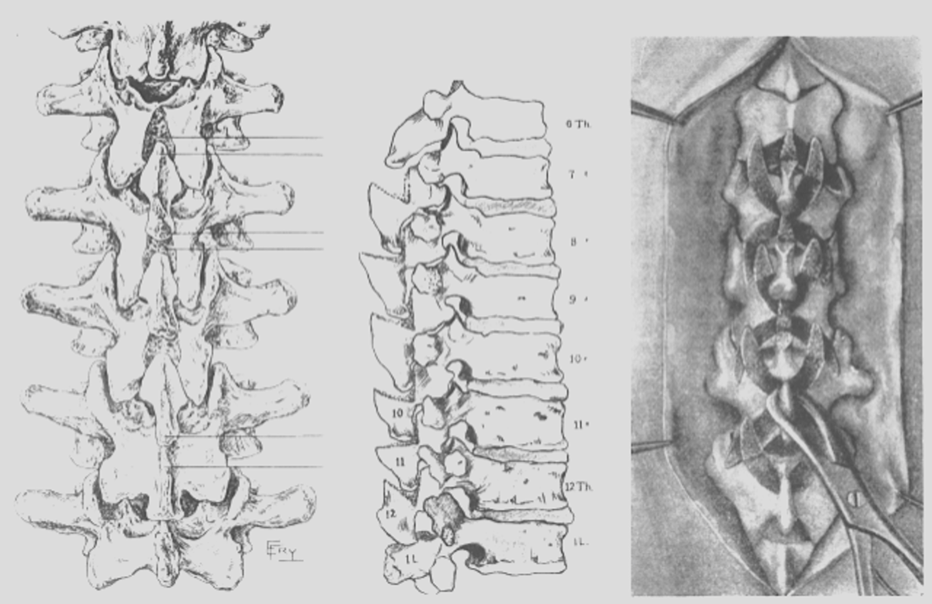 Cureus History of Bone Grafts in Spine Surgery