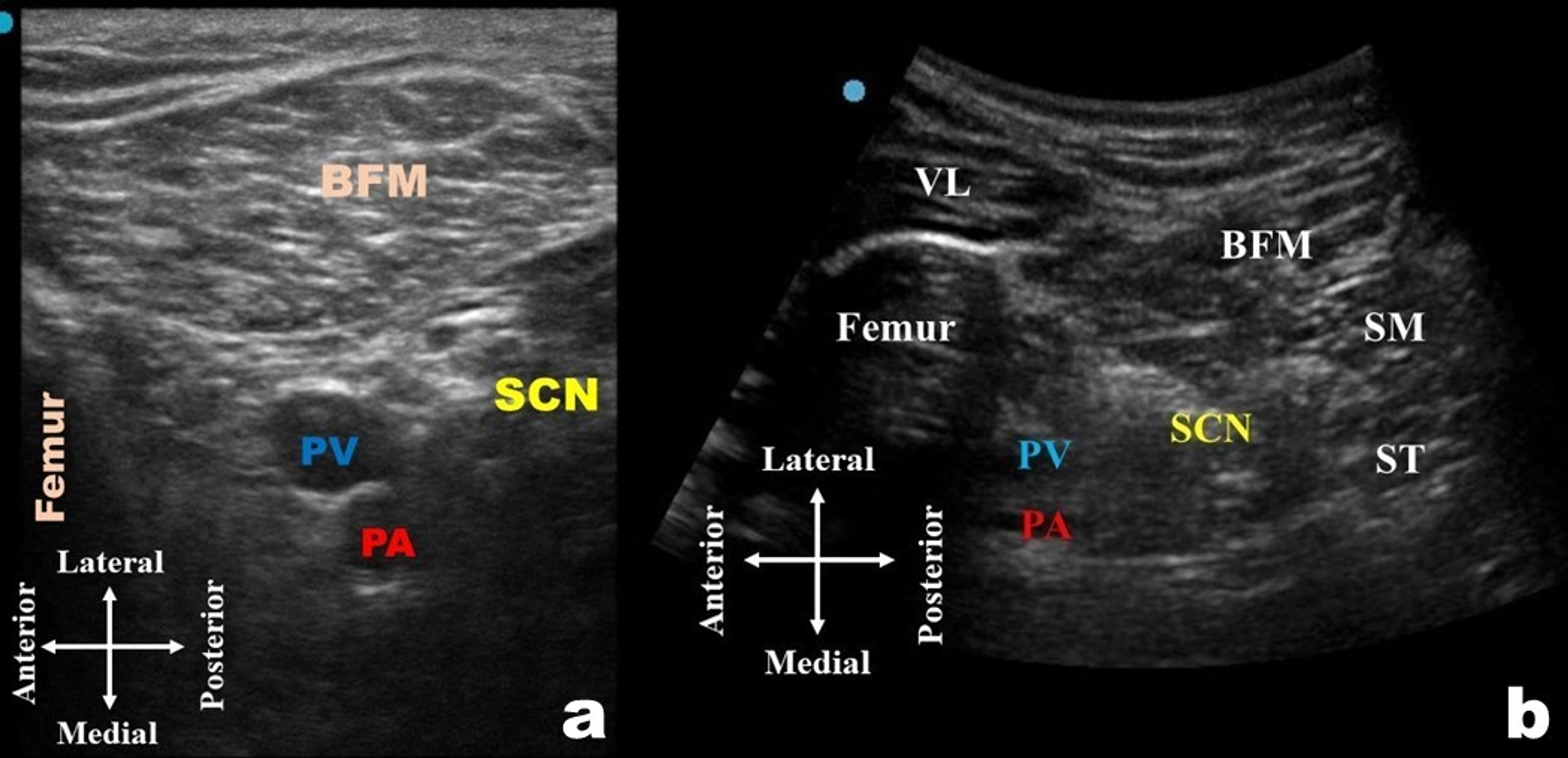 Cureus Ultrasound Guided Caps Crosswise Approach To Popliteal