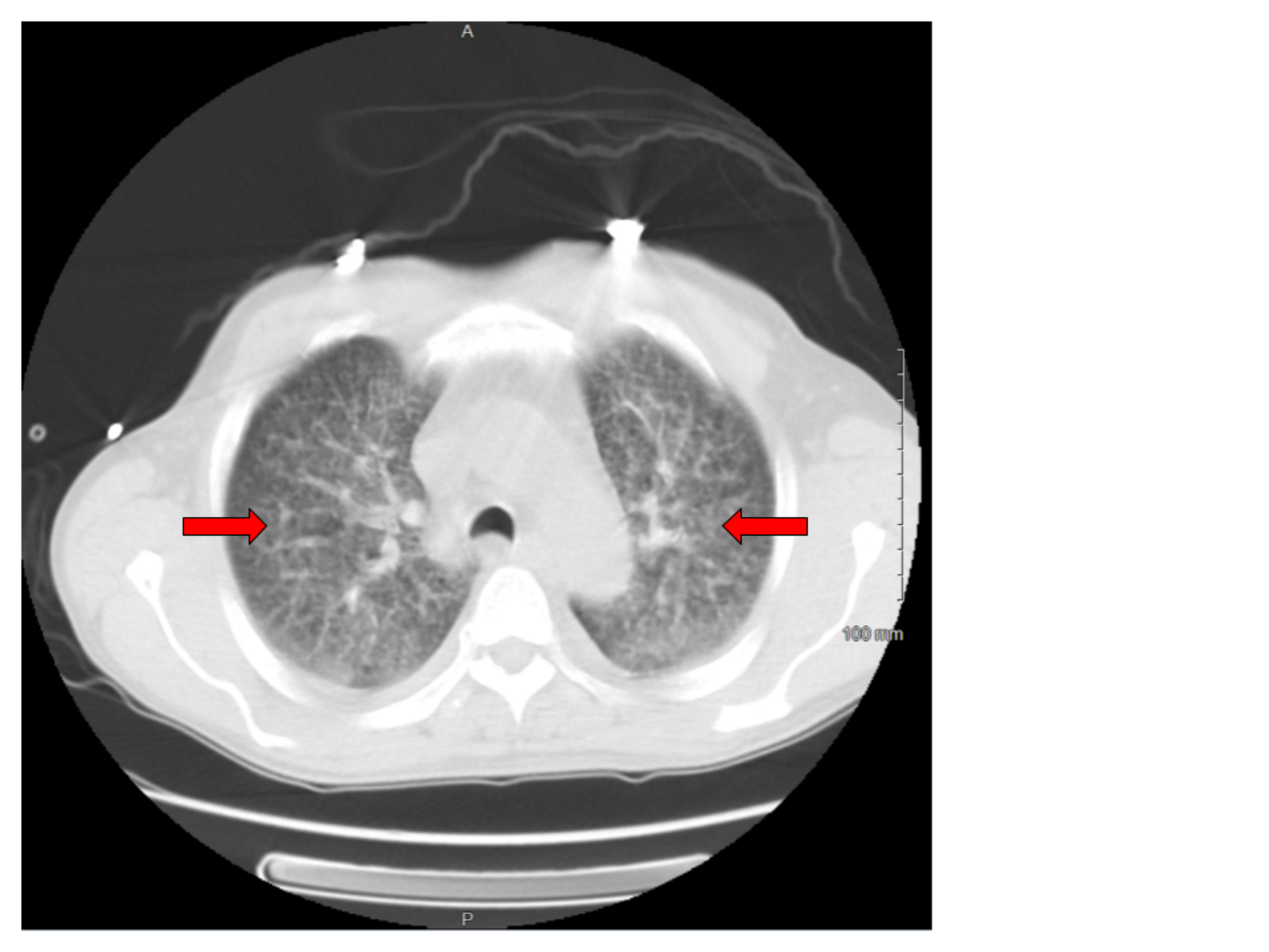 Cureus Disseminated Histoplasmosis Presenting As Acute Respiratory Distress Syndrome And